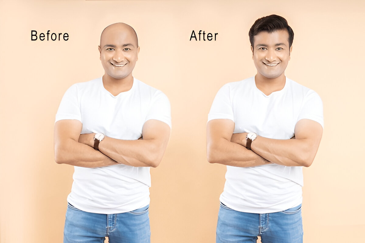 Best Practices for FUE Hair Transplant Aftercare in London