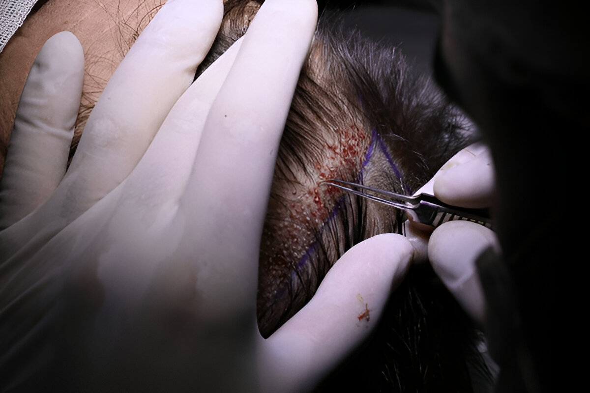What Should You Expect from a Hair Transplant Consultation?